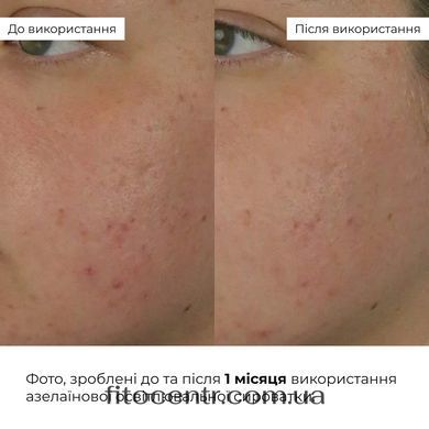 Комплекс Hillary для жирного типа кожи с азелаиновой кислотой - 10
