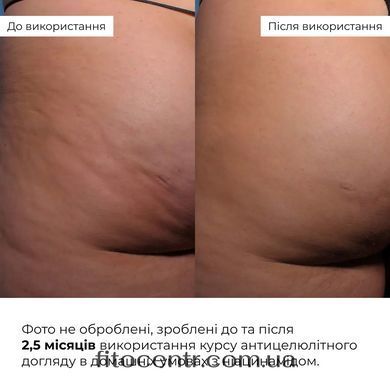 Курс Hillary антицеллюлитного ухода в домашних условиях с ниацинамидом - 4