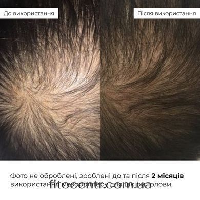 Hillary scalp mesoscooter + MULTI-ACTIVE HOP CONES hair serum