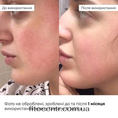 Spring care for oily skin Hillary
